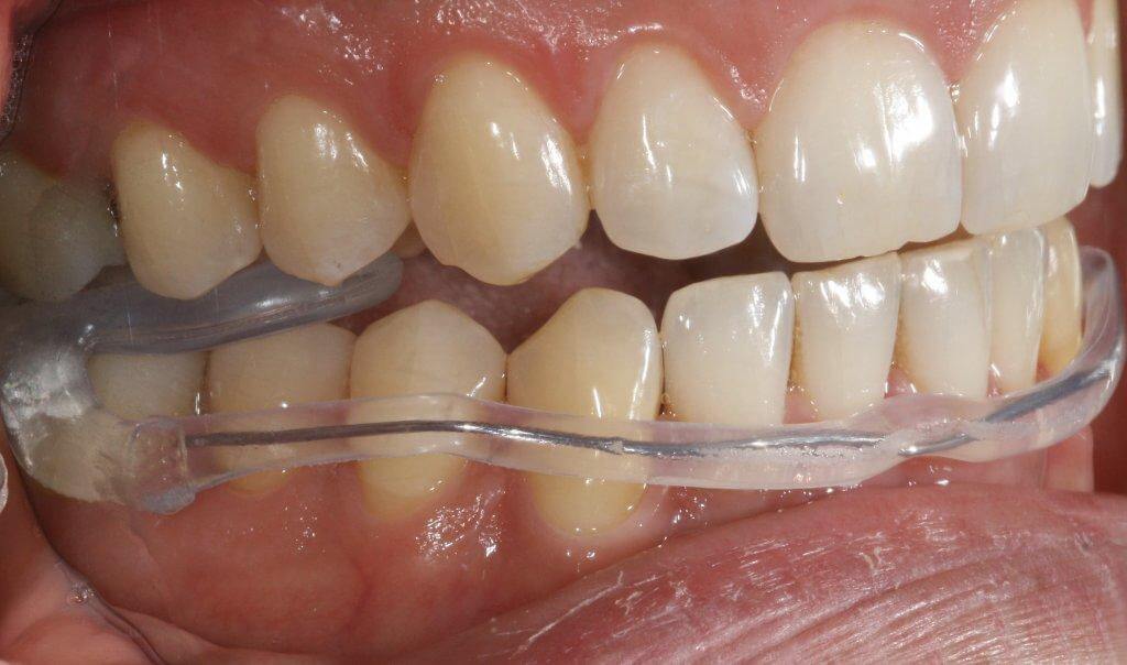 AquaSplint mini (5er Pack)