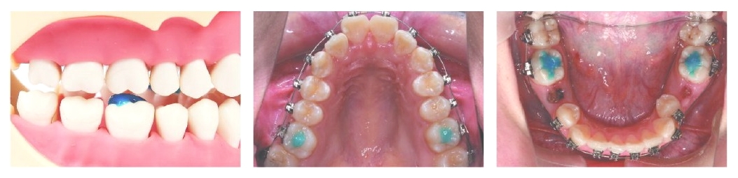 Band Zement "BLUE" Spritze