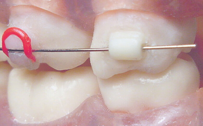 Mini Mold® Starter Kit