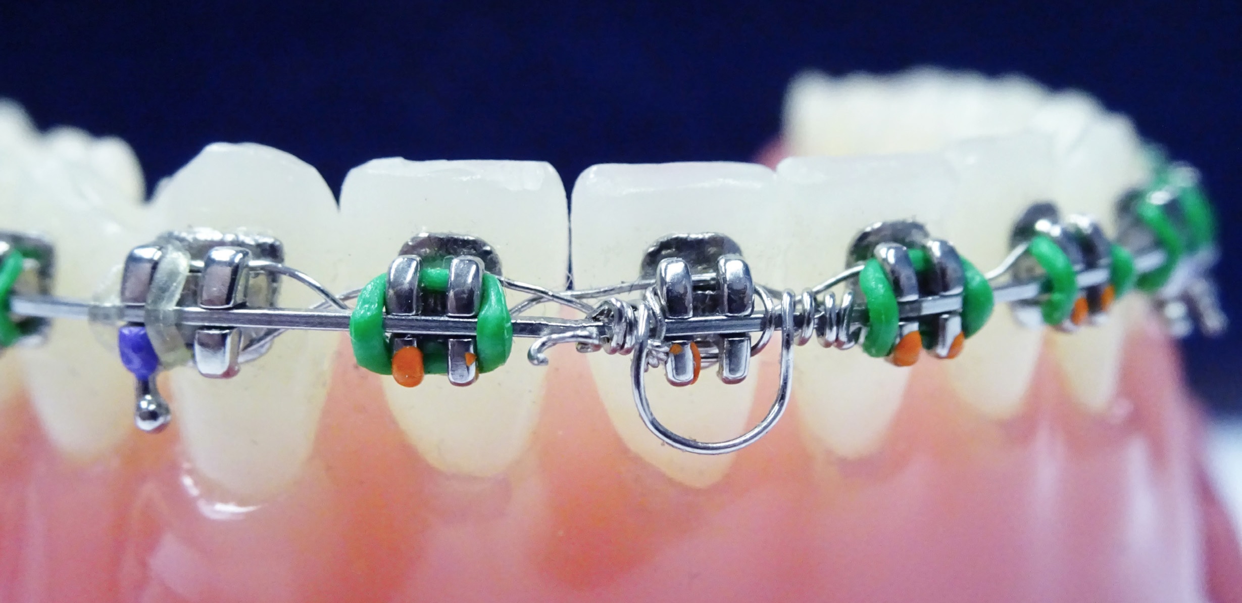 GTS - Goodman Torquing Spring Set