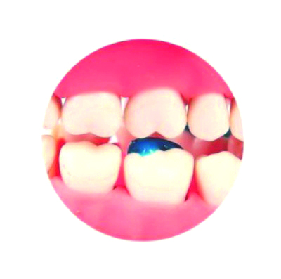 Band Cement "Blue" Set