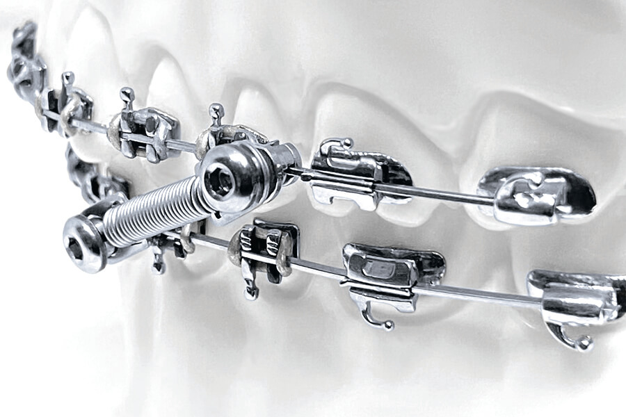 CS5 Twist Lock, 5-Patienten Kit (7 mm)