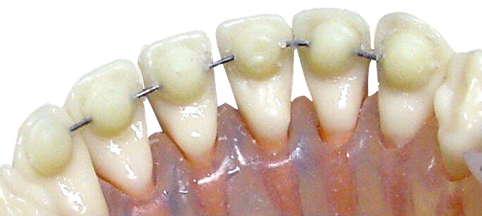 Mini Mold® Retainer, large