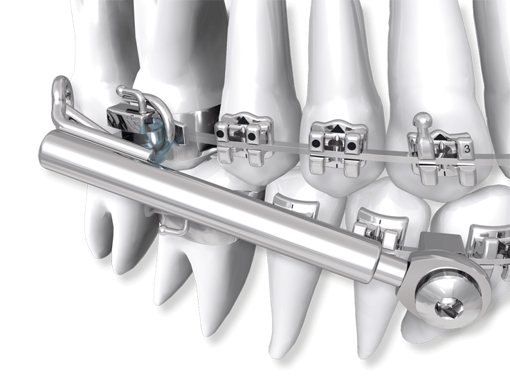 SUS³ - Set with installation key (starter set)