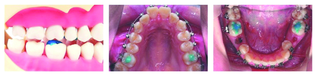 Band Cement "Blue" Syringe