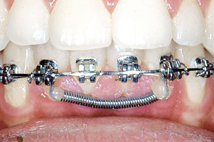 Huckepackfeder Starterset, 1 Stk. je Größe