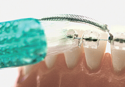 Huckepackfeder Starterset, 1 Stk. je Größe